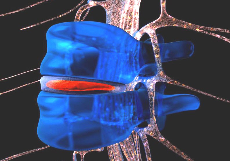 Межпозвонковая грыжа: профилактика, симптомы и лечение - medikey.ru